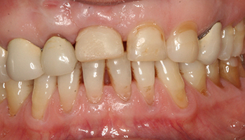 Yellow and worn teeth