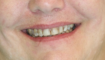 Severely decayed and discolored teeth