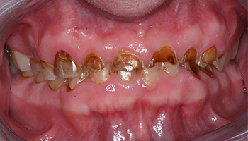 Severely decayed teeth