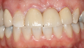 Gap between teeth closed