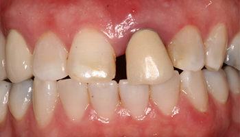 Gap between top teeth