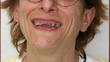 Smile with several missing teeth