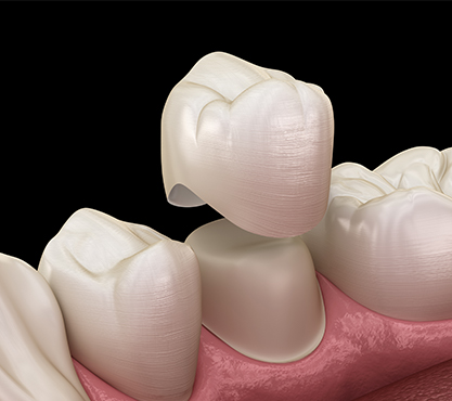 Animated dental crown placement