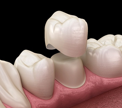 Dental crowns Richardson 3D illustration