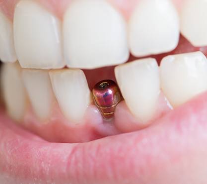 a person with a dental implant placed in their mouth