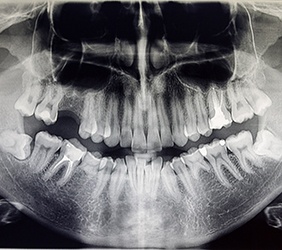 an X-ray of a person’s jawbone and facial structure