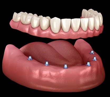 full denture supported by six dental implants