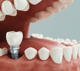 Illustrated diagram of dental implant in the lower jaw