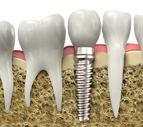 Diagram of dental implant in Richardson during osseointegration