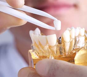 Dentist holding model of the jaw in one hand and dental crown in the other