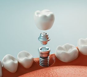 single dental implant with a crown