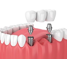 two dental implants supporting a dental bridge