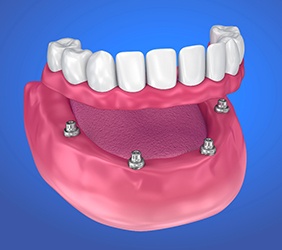 four dental implants supporting a full implant denture