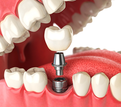 Animation of dental implant placement