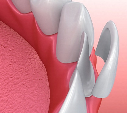 Illustration of veneers