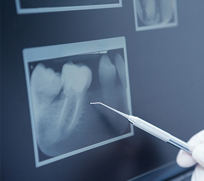 Dental x rays on computer screen
