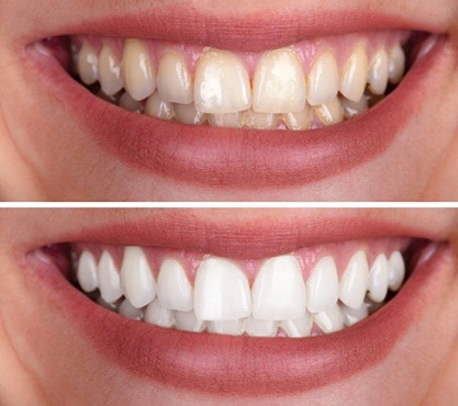 Smile before and after whitening