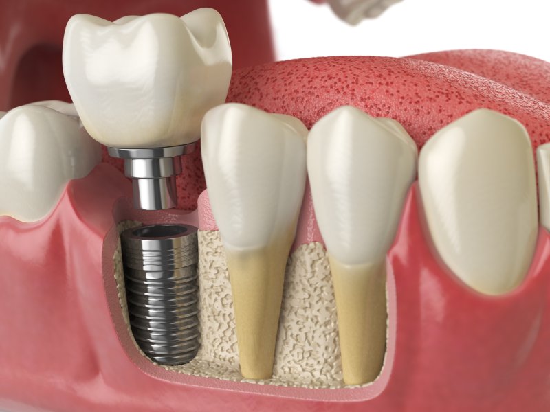 Illustration of dental implant in Richardson