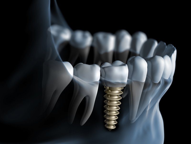 Dental implant digital image