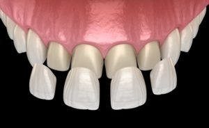 veneers 3D illustration